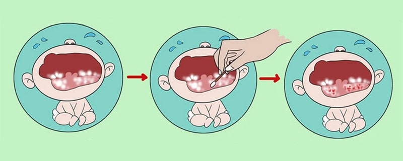 嬰兒鵝口瘡最佳治療方法