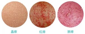 痱子是什么