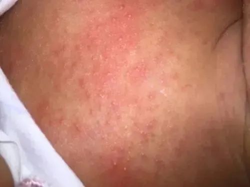 痱子是什么
